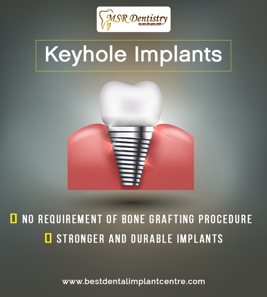 Keyhole Dental Implants in chennai